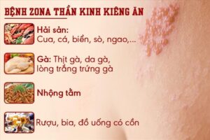 không nên ăn gì khi mắc bệnh zona