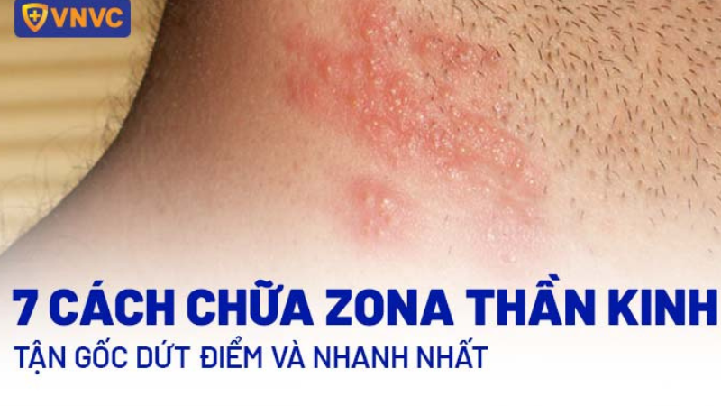 bệnh zona thần kinh