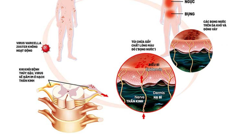 nguyên nhân bệnh zona