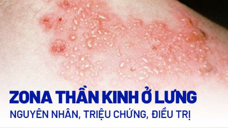 triệu chứng bệnh zona