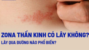 bệnh zona lây qua đường nào