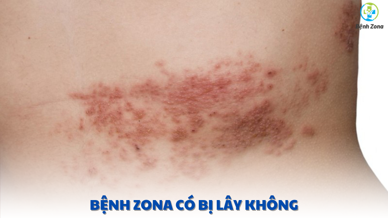 bệnh zona có bị lây không