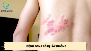 bệnh zona có bị lây không