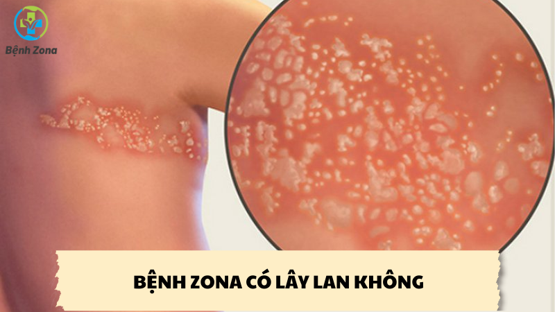 bệnh zona có lây lan không